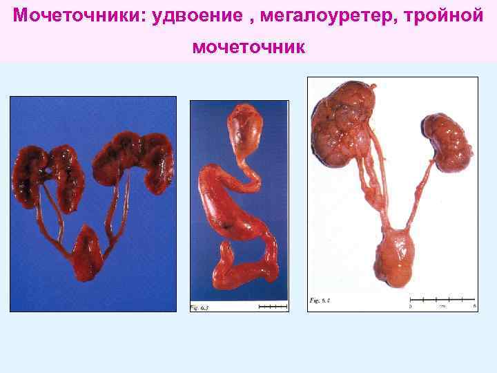 Мочеточники: удвоение , мегалоуретер, тройной мочеточник 