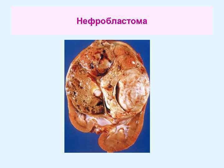 Нефробластома 
