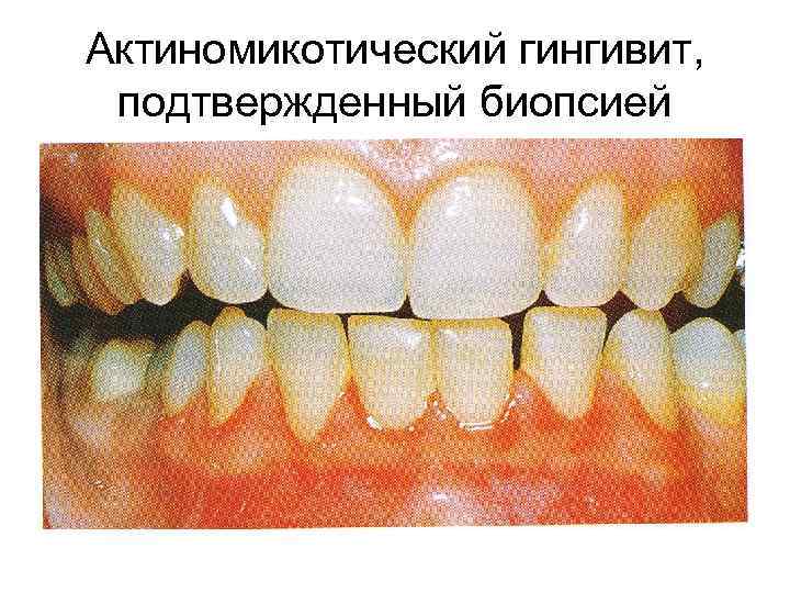 Актиномикотический гингивит, подтвержденный биопсией 