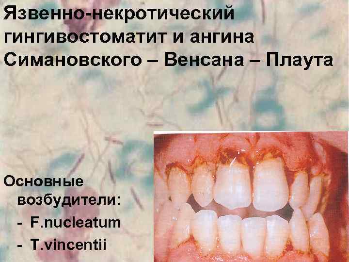 Язвенно-некротический гингивостоматит и ангина Симановского – Венсана – Плаута Основные возбудители: - F. nucleatum