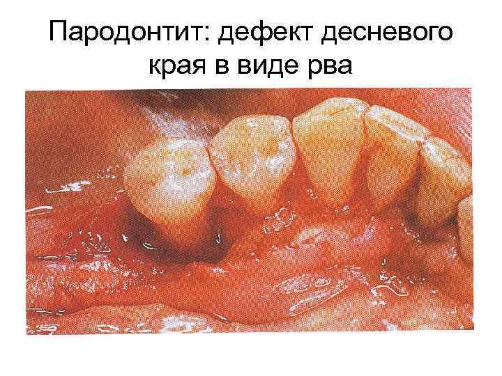 Пародонтит: дефект десневого края в виде рва 