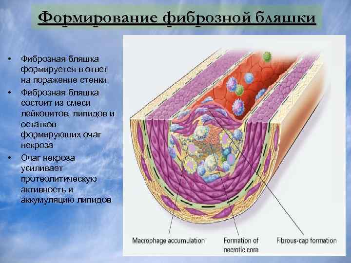 Формирование фиброзной бляшки • • • Фиброзная бляшка формируется в ответ на поражение стенки