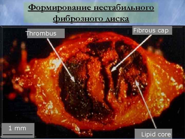 Формирование нестабильного фиброзного диска • • • Thrombus Fibrous cap Фиброзная бляшка быстро приводит