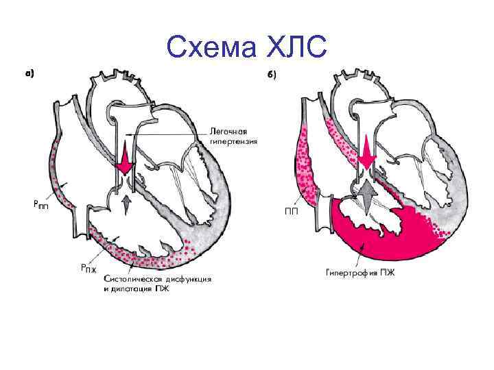 Легочная гипертензия картинки