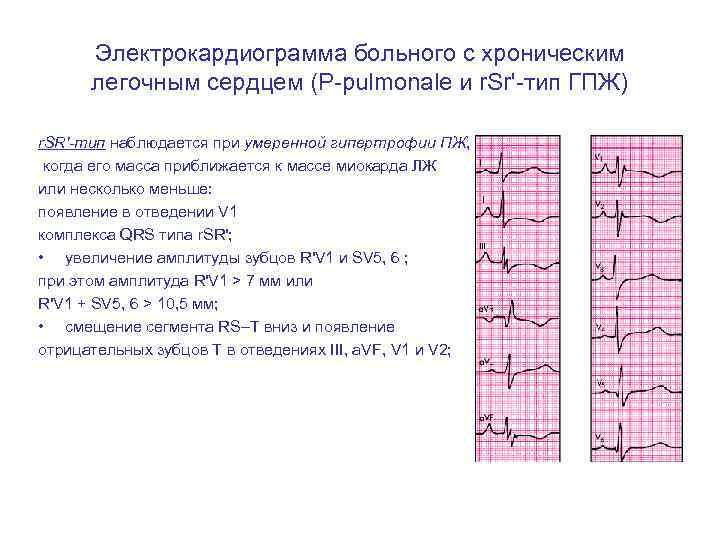 Электрокардиограмма больного с хроническим легочным сердцем (Р-pulmonale и r. Sr'-тип ГПЖ) r. SR'-тип наблюдается