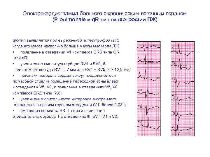 Электрокардиограмма больного с хроническим легочным сердцем (Р-pulmonale и q. R-тип гипертрофии ПЖ) q. R-тип