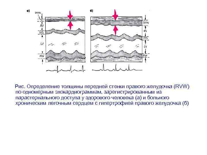  Рис. Определение толщины передней стенки правого желудочка (RVW) по одномерным эхокардиограммам, зарегистрированным из