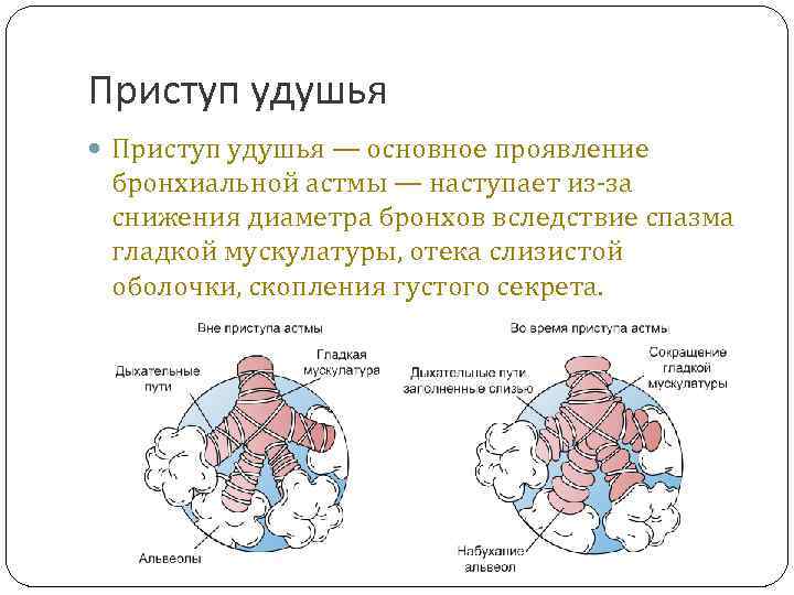 Приступ удушья — основное проявление бронхиальной астмы — наступает из-за снижения диаметра бронхов вследствие