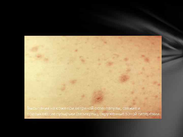Высыпания на коже при ветряной оспе: папулы, свежие и подсыхающие пузырьки (везикулы), окруженные зоной