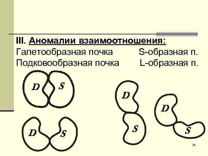 III. Аномалии взаимоотношения: Галетообразная почка S-образная п. Подковообразная почка L-образная п. D S D