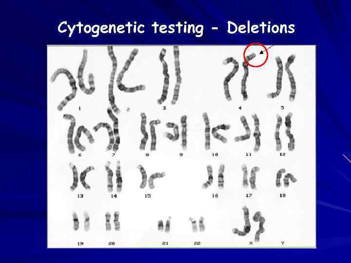 Cytogenetic testing - Deletions 