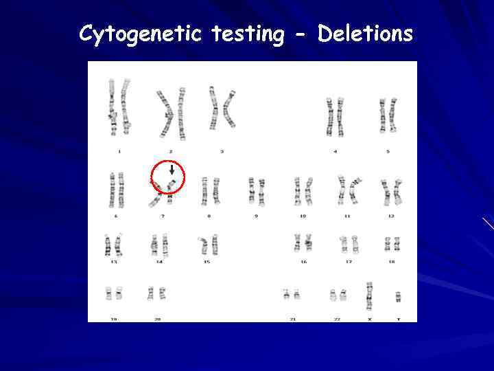 Cytogenetic testing - Deletions 