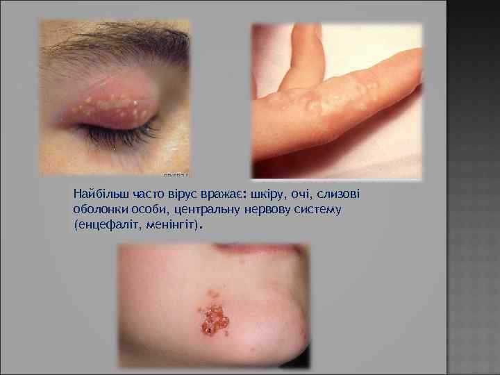 Найбільш часто вірус вражає: шкіру, очі, слизові оболонки особи, центральну нервову систему (енцефаліт, менінгіт).