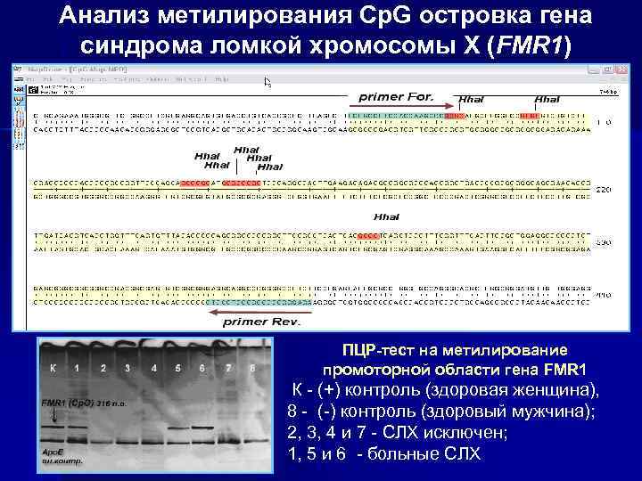 Анализ метилирования Cp. G островка гена синдрома ломкой хромосомы Х (FMR 1) ПЦР-тест на