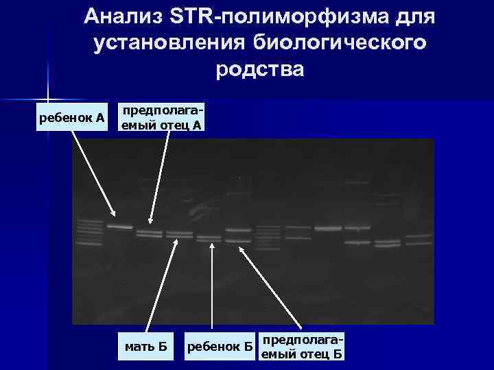 Анализ STR-полиморфизма для установления биологического родства ребенок А предполагаемый отец А мать Б ребенок