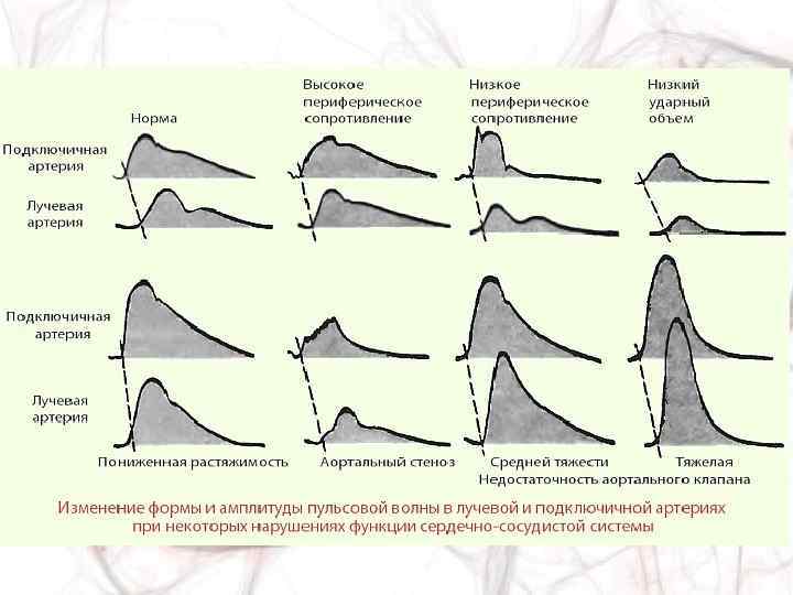 Нормальная волна. Форма пульсовой волны норма. Патологические формы пульсовой волны. Кривая пульсовой волны. Формы Кривой пульсовой волны.