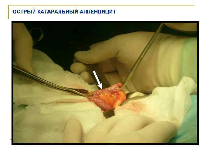 ОСТРЫЙ КАТАРАЛЬНЫЙ АППЕНДИЦИТ 