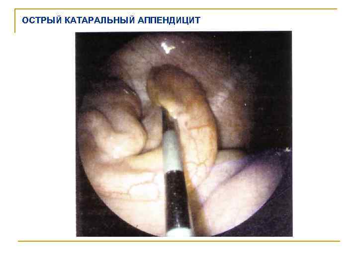 ОСТРЫЙ КАТАРАЛЬНЫЙ АППЕНДИЦИТ 