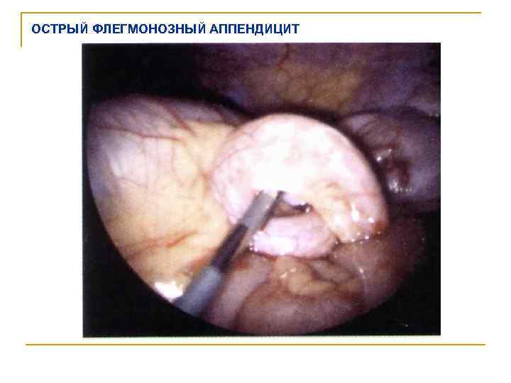 ОСТРЫЙ ФЛЕГМОНОЗНЫЙ АППЕНДИЦИТ 