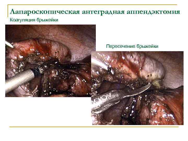 Лапароскопическая антеградная аппендэктомия Коагуляция брыжейки Пересечение брыжейки 