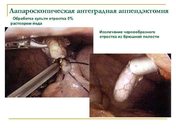 Лапароскопическая антеградная аппендэктомия Обработка культи отростка 5% раствором йода Извлечение червеобразного отростка из брюшной