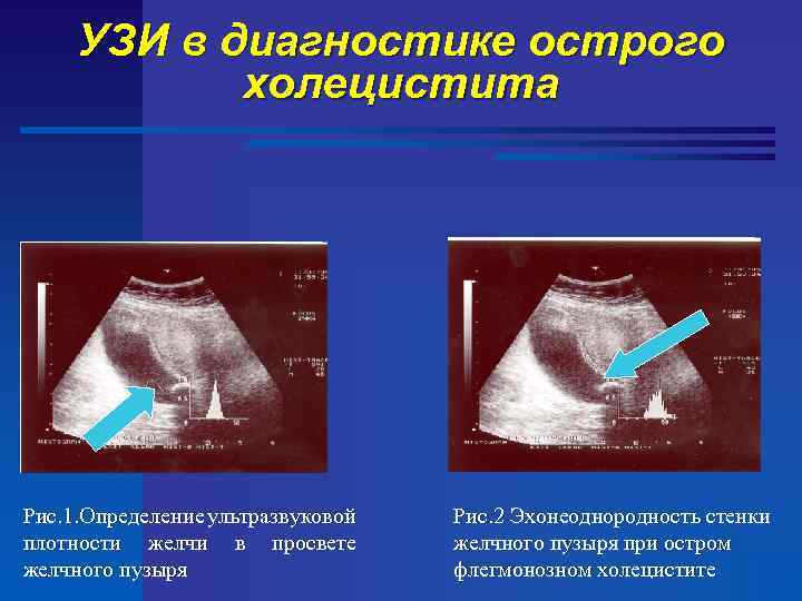 УЗИ в диагностике острого холецистита Рис. 1. Определение ультразвуковой плотности желчи в просвете желчного
