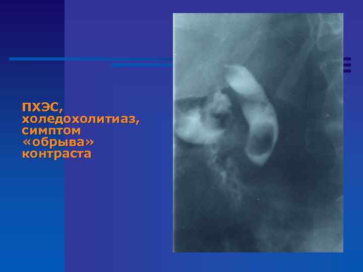 ПХЭС, холедохолитиаз, симптом «обрыва» контраста 