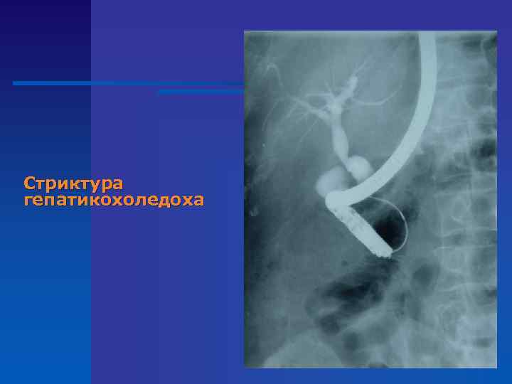 Стриктура гепатикохоледоха 