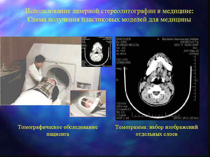 Использование лазерной стереолитографии в медицине: Схема получения пластиковых моделей для медицины Томографическое обследование пациента