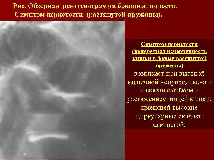 Рис. Обзорная рентгенограмма брюшной полости. Симптом перистости (растянутой пружины). Симптом перистости (поперечная исчерченность кишки