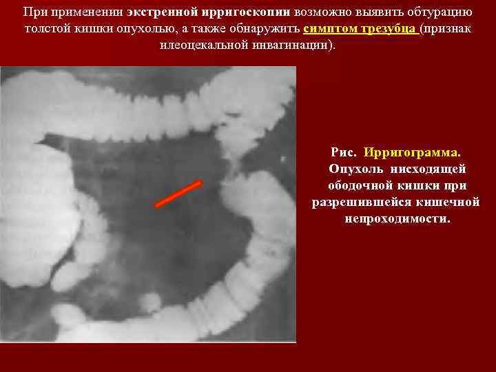 При применении экстренной ирригоскопии возможно выявить обтурацию толстой кишки опухолью, а также обнаружить симптом