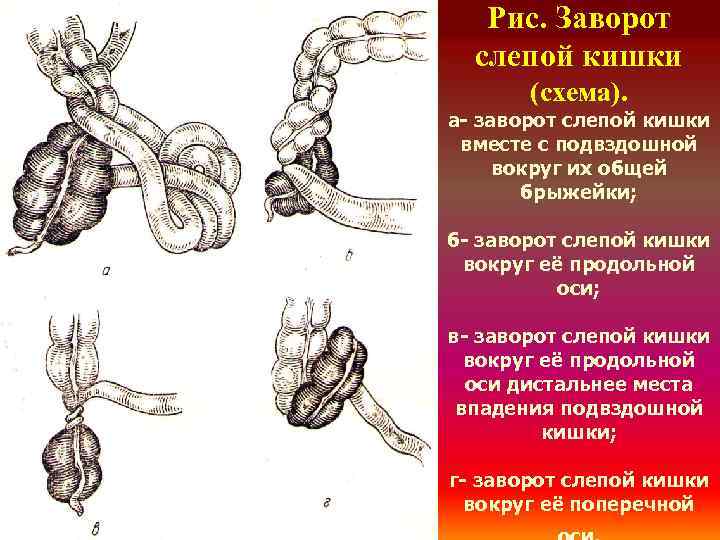 Рис. Заворот слепой кишки (схема). а- заворот слепой кишки вместе с подвздошной вокруг их