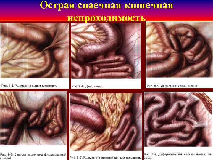 Острая спаечная кишечная непроходимость 