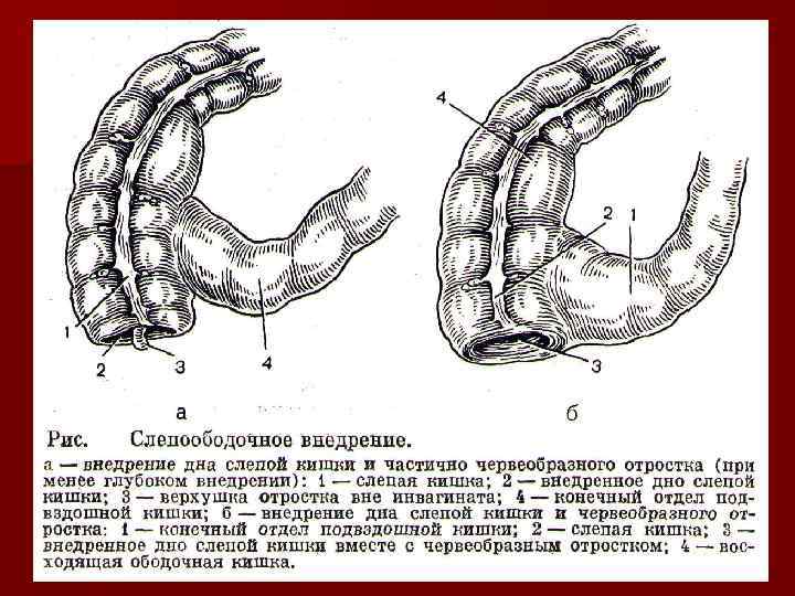 Симптомы заворота кишок