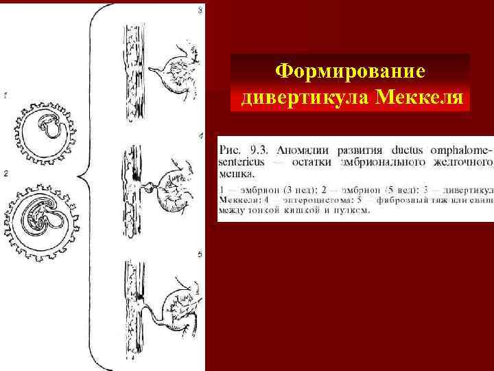 Формирование дивертикула Меккеля 