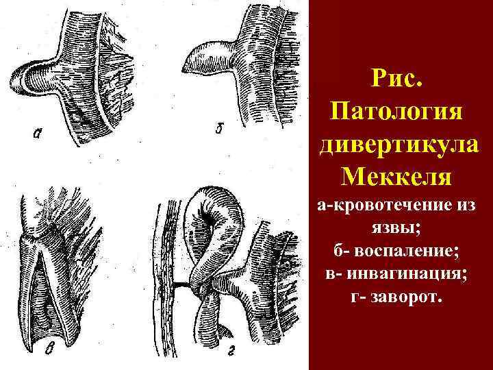 Рис. Патология дивертикула Меккеля а-кровотечение из язвы; б- воспаление; в- инвагинация; г- заворот. 
