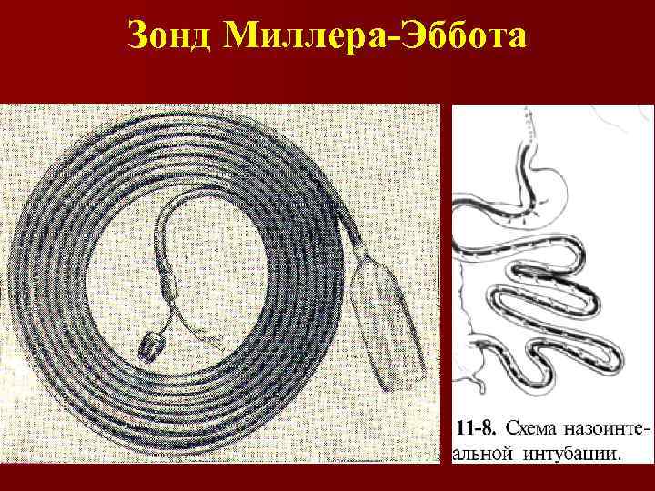 Зонд Миллера-Эббота 