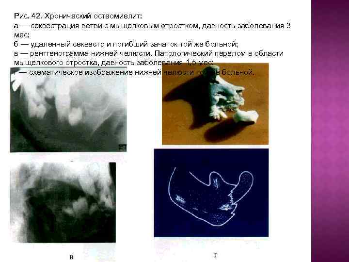Рис. 42. Хронический остеомиелит: а — секвестрация ветви с мыщелковым отростком, давность заболевания 3