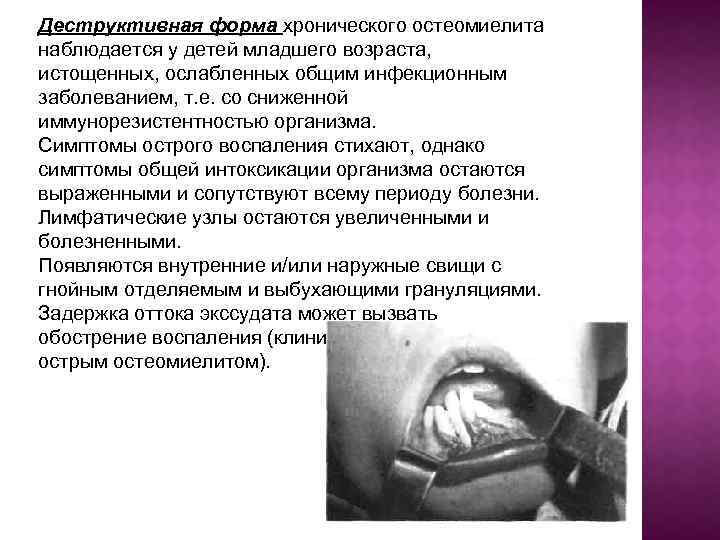 Деструктивная форма хронического остеомиелита наблюдается у детей младшего возраста, истощенных, ослабленных общим инфекционным заболеванием,