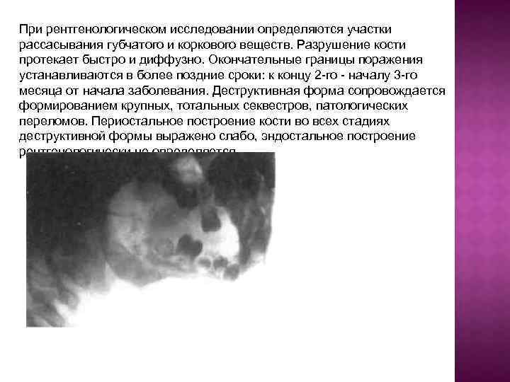 При рентгенологическом исследовании определяются участки рассасывания губчатого и коркового веществ. Разрушение кости протекает быстро