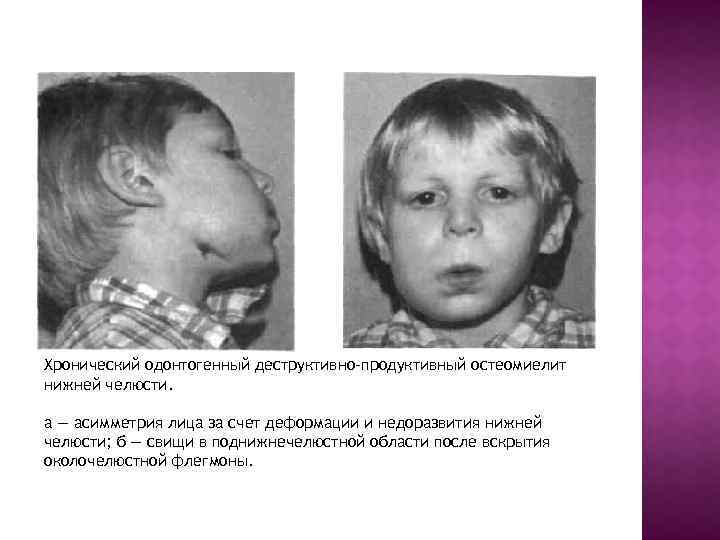 Хронический одонтогенный деструктивно-продуктивный остеомиелит нижней челюсти. а — асимметрия лица за счет деформации и