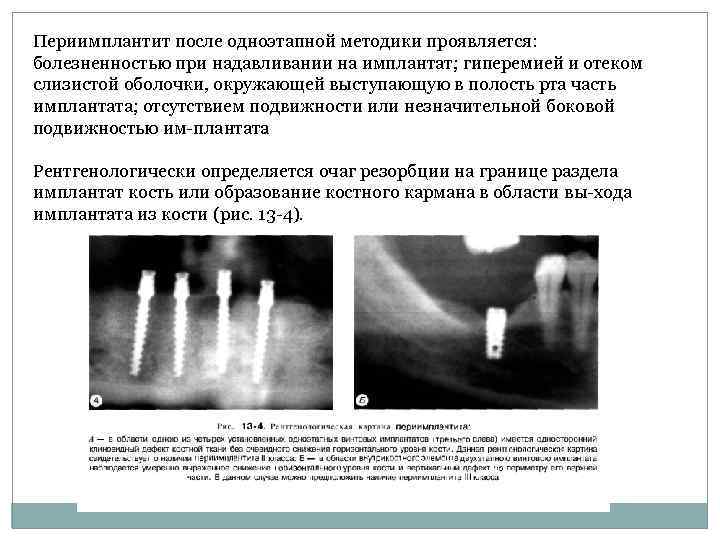 Периимплантит после одноэтапной методики проявляется: болезненностью при надавливании на имплантат; гиперемией и отеком слизистой
