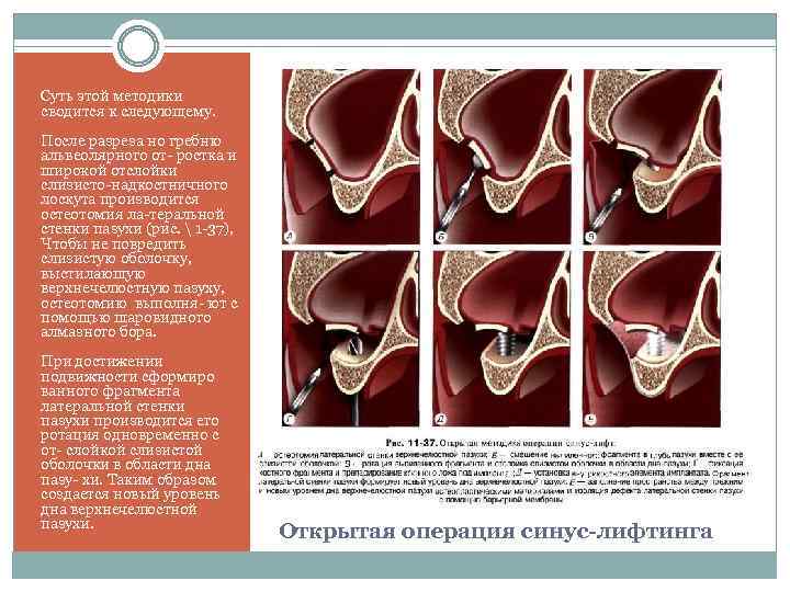Суть этой методики сводится к следующему. После разреза но гребню альвеолярного от ростка и