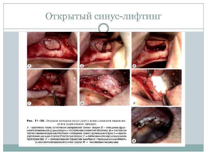 Открытый синус лифтинг 