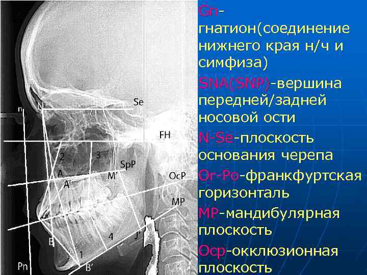 n n n Gnгнатион(соединение нижнего края н/ч и симфиза) SNA(SNP)-вершина передней/задней носовой ости N-Se-плоскость