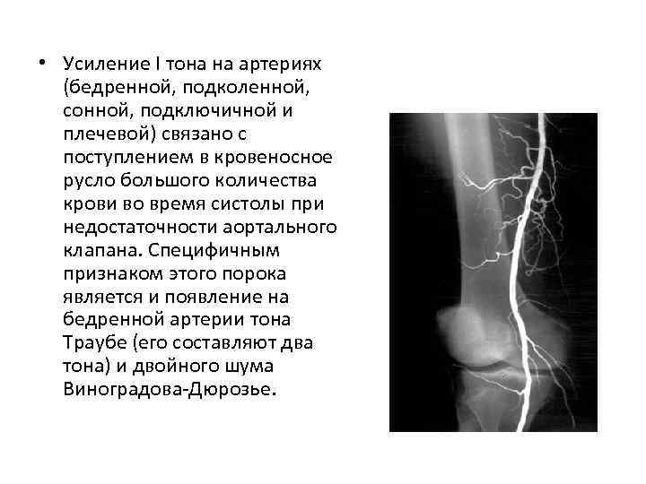  • Усиление I тона на артериях (бедренной, подколенной, сонной, подключичной и плечевой) связано