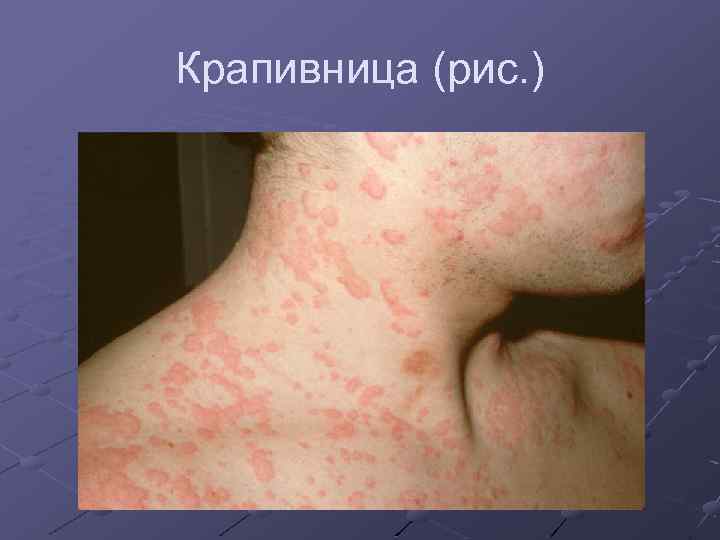 Крапивница (рис. ) 