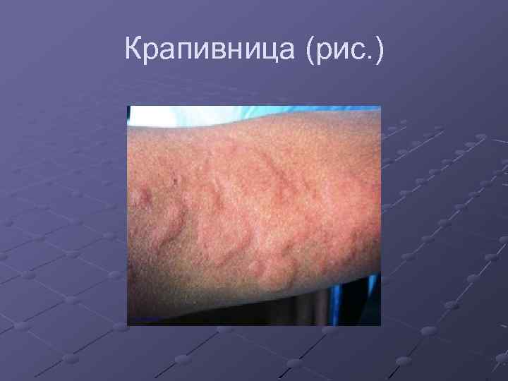 Крапивница (рис. ) 