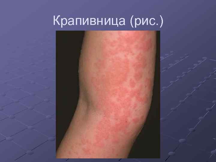 Крапивница (рис. ) 