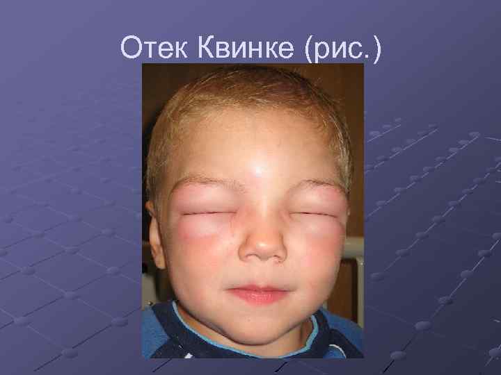 Отек Квинке (рис. ) 